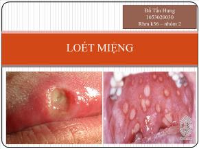 Bài giảng Loét miệng - Đỗ Tấn Hưng