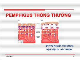 Pemphigus thông thường